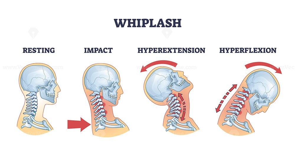 Person holding neck after car accident whiplash injury Pittsburgh